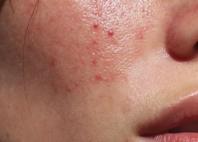 Breakouts & blemish-prone skin