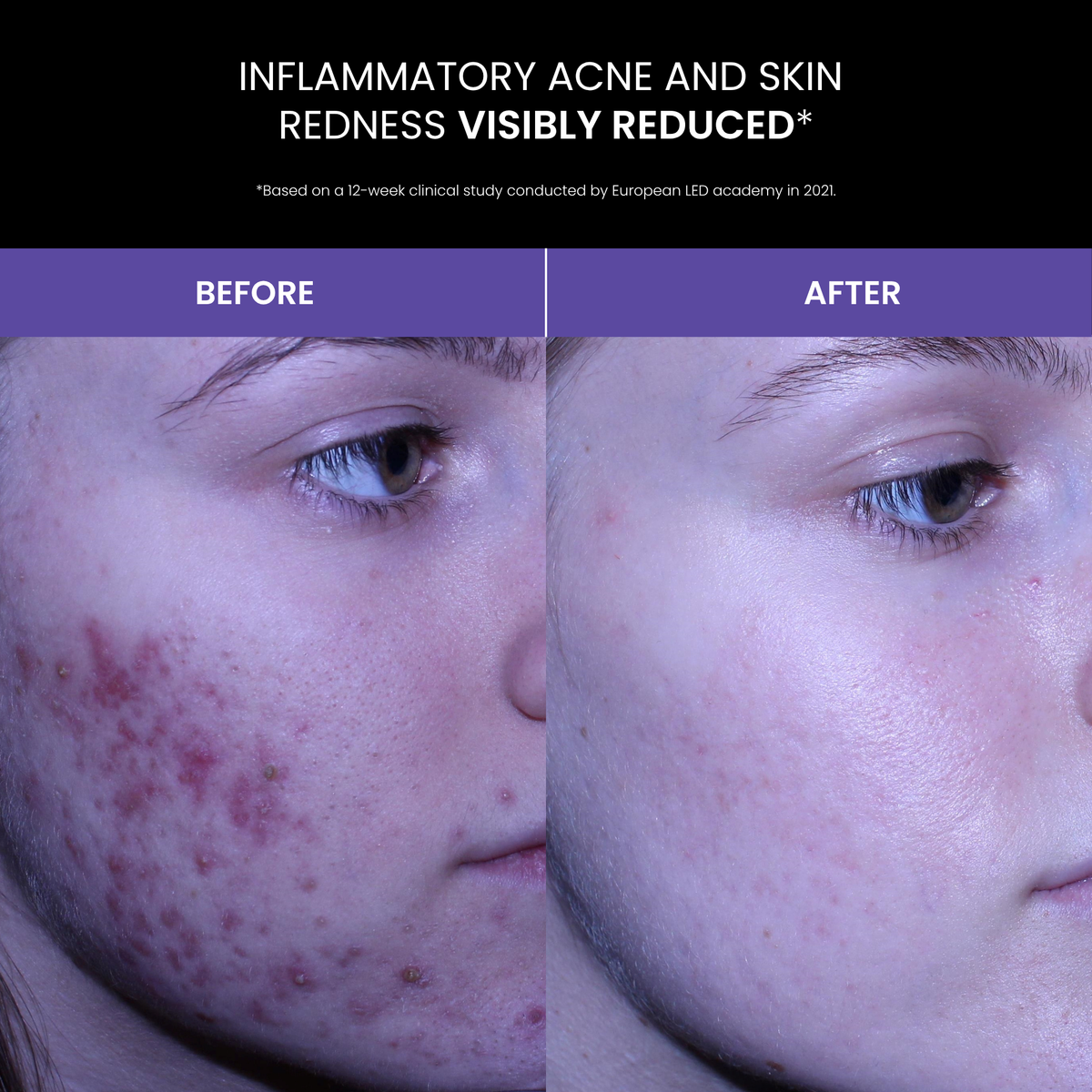 Lustre SOLO: Blue Light Therapy for Acne