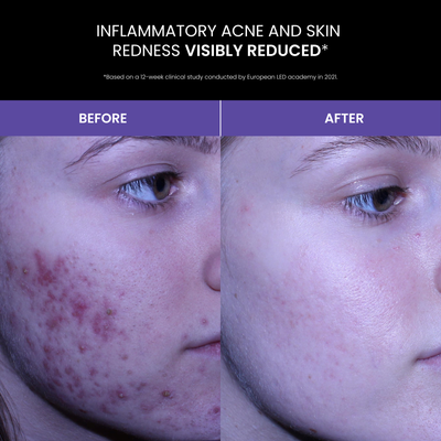 Lustre SOLO: Blue Light Therapy for Acne