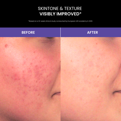 Lustre SOLO: Blue Light Therapy for Acne